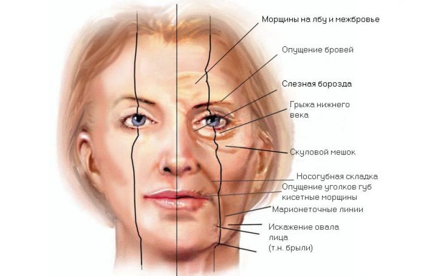 Подтяжка кожи лица
