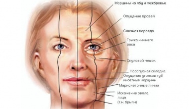 Подтяжка кожи лица
